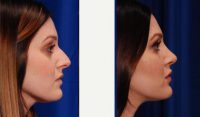 Dr Kamran Khoobehi, MD, New Orleans Plastic Surgeon - 25 Year Old Woman Treated With Rhinoplasty