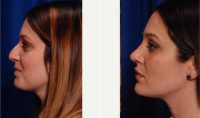 Dr Kamran Khoobehi, MD, New Orleans Plastic Surgeon - 34 Year Old Woman Treated With Rhinoplasty Before