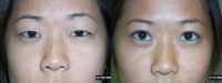 Asian Eye Lid Surgery