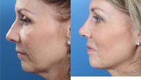 Primary septorhinoplasty and pre-jowl filler with Juvederm