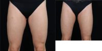 45-54 year old woman treated with BodyTite to inner thighs