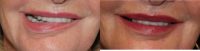65-74 year old woman treated with Botox and Filler