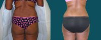 Buttocks augmentation with implants and fat grafting