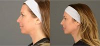Nonsurgical Chin Augmentation in 37-year-old Female Patient