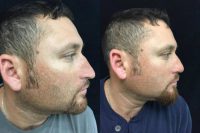 34 year old man treated with Reconstructive Rhinoplasty
