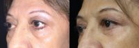 55-64 year old woman treated with lower eyelid blepharoplasty
