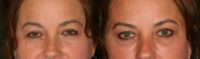 35-44 year old woman treated with Restylane, Perlane and Botox