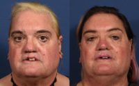55-64 year old woman treated with Revision of Cleft Lip, Brow Bone Reduction and Cheek Augmentation