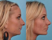25-34 year old woman treated with Rhinoplasty