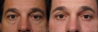 45-54 year old man treated with Eyelid Surgery