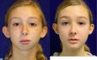 16 - 20 year old woman treated with Orthognathic Surgery