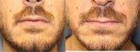 25-34 year old man treated with Juvederm
