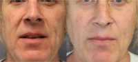 55-64 year old man treated with Cheek Augmentation