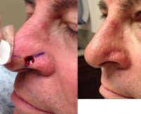 65-74 year old man treated with Nose Surgery