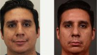 Dr Parker A. Velargo, MD, New Orleans Facial Plastic Surgeon - 29 Year Old Man Treated With Rhinoplasty After Nasal Fracture
