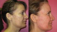 35-44 year old woman treated with Skin Rejuvenation