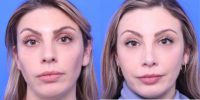 31 year old woman treated with Browbone Reduction, Browlift, and Rhinoplasty