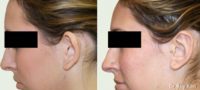 Otoplasty-Ear Surgery