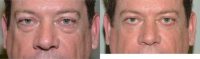 65-74 year old man treated with Lower Eyelid Surgery