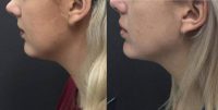 24 year old treated with Kybella
