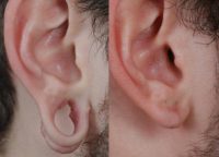 18-24 year old man treated with Ear Lobe Surgery