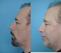 45-54 year old man treated with Rhinoplasty
