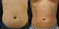 45-54 year old man treated with Smart Lipo