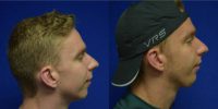 18-24 year old man treated with Chin Implant