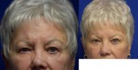 75 and up year old woman treated with Brow Lift