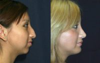 Open Rhinoplasty and Chin Augmentation