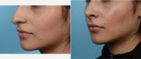 Dr Thomas A. Mustoe, MD, FACS, Chicago Plastic Surgeon - 24 Year Old Woman Treated With Rhinoplasty