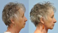 64 year old woman treated with face & neck lift