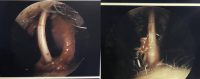 35-44 year old man treated with Septoplasty
