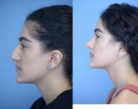 18-24 year old woman treated with a Cosmetic Rhinoplasty