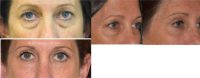 35-44 year old woman treated with Eyelid Surgery