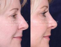 35 year old woman treated with Rhinoplasty