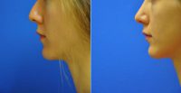 Dr. Adam Bryce Weinfeld, MD, Austin Plastic Surgeon - Rhinoplasty - For Appearance And Breathing