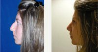 Dr. Andres Gantous, MD, Toronto Facial Plastic Surgeon - 24 Year Old Woman Treated With Rhinoplasty