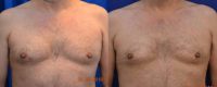 55-64 year old man treated with Male Breast Reduction