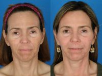 Female patient who wanted nonsurgical rejuvenation.