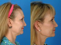 Patient interested in improving her neck, jawline and brow.
