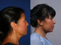 35 year-old woman, Neck Lift