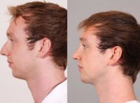 25 year old man with primary rhinoplasty and chin implant.