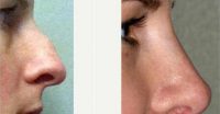 Dr. Barry L. Eppley, MD, DMD, Indianapolis Plastic Surgeon - 34 Year Old Woman Treated With Rhinoplasty