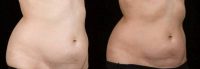 Woman treated with SculpSure