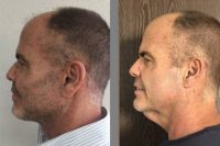 Man treated with Deep Plane Facelift