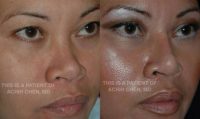 39 year old woman treated with Rhinoplasty