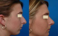 Rhinoplasty (Nose Reshaping) and Chin Implant