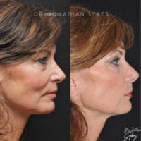 Woman in her early 60s treated with Facelift