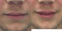 35-44 year old man treated with Juvederm